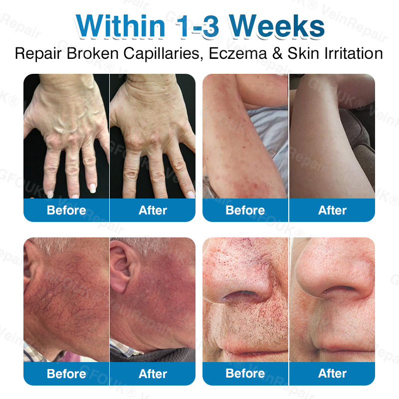 🇨🇦👨‍⚕️✅👍GFOUK® VeinRepair Microneedle Patch Roll⚡Instant Relief, Long-Term Results