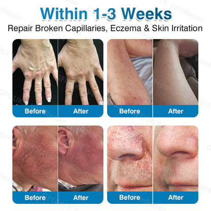 🇨🇦👨‍⚕️✅👍GFOUK® VeinRepair Microneedle Patch Roll⚡Instant Relief, Long-Term Results