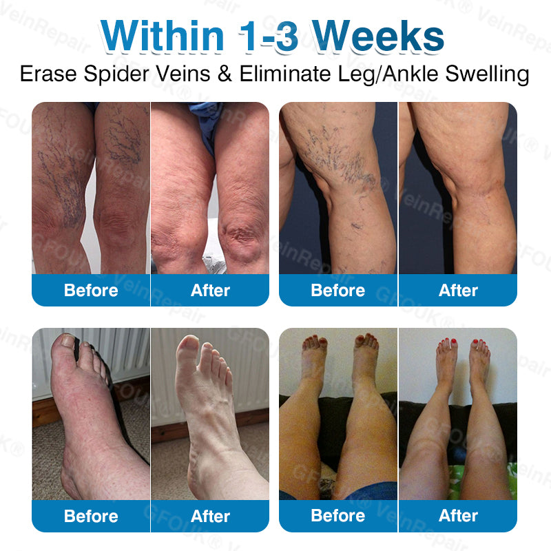 🇨🇦👨‍⚕️✅👍GFOUK® VeinRepair Microneedle Patch Roll⚡Instant Relief, Long-Term Results