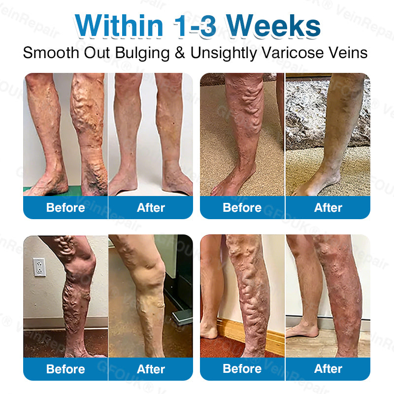🇨🇦👨‍⚕️✅👍GFOUK® VeinRepair Microneedle Patch Roll⚡Instant Relief, Long-Term Results